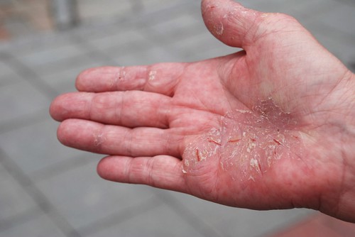 Bong tróc da tay da chân – Dấu hiệu cảnh báo bệnh chàm khô bạn nên nắm rõ
